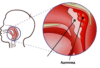 аденоид