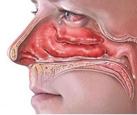 Гипертрофический ринит, симптомы и лечение