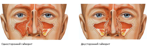 Виды гайморита