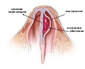 Доброкачественные образования носа — Заболевания - причины, симптомы, диагностика в СПб