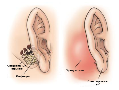 mastoiditis