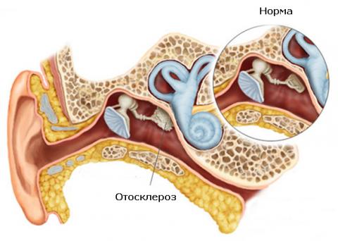 Отосклероз
