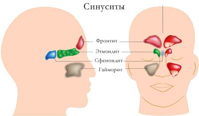 Сфеноидит (синусит, гайморит) лечение народными средствами в домашних условиях