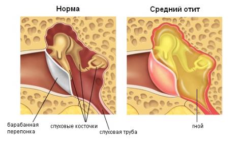 Обморожение: степени, первая помощь, профилактика