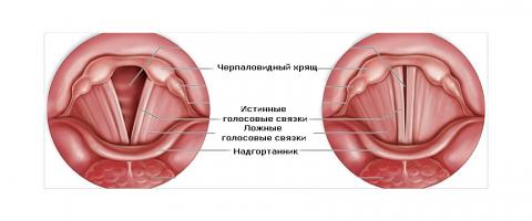 Охриплость. Её причины и лечение